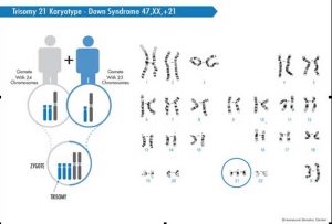 down_syndrome