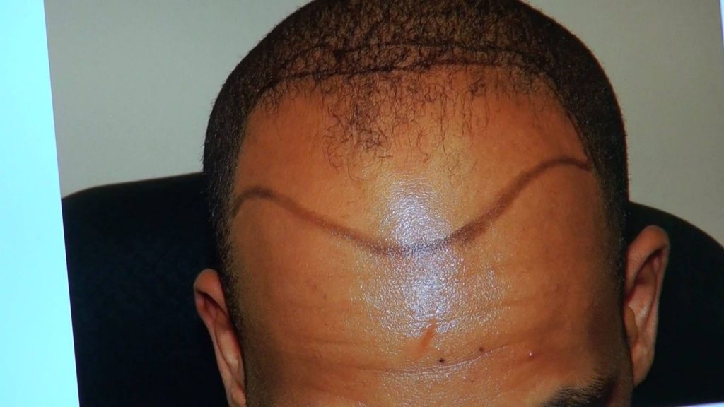 receding hairline