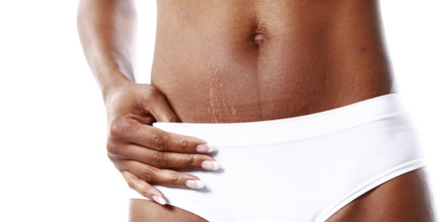 ways to get rid of stretch marks