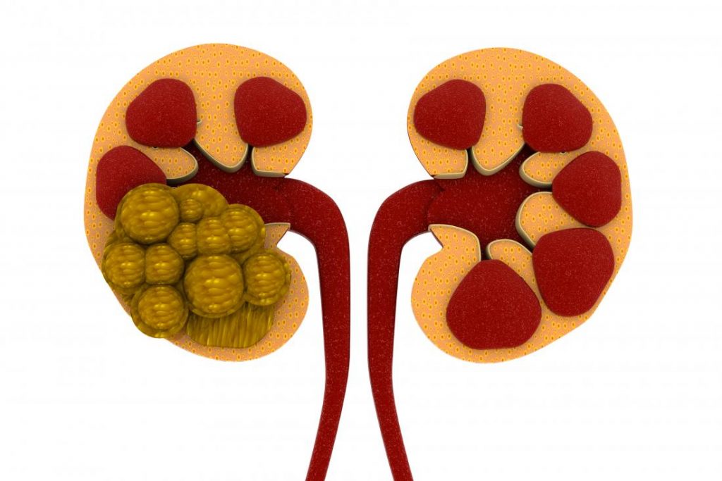 Kidney stons