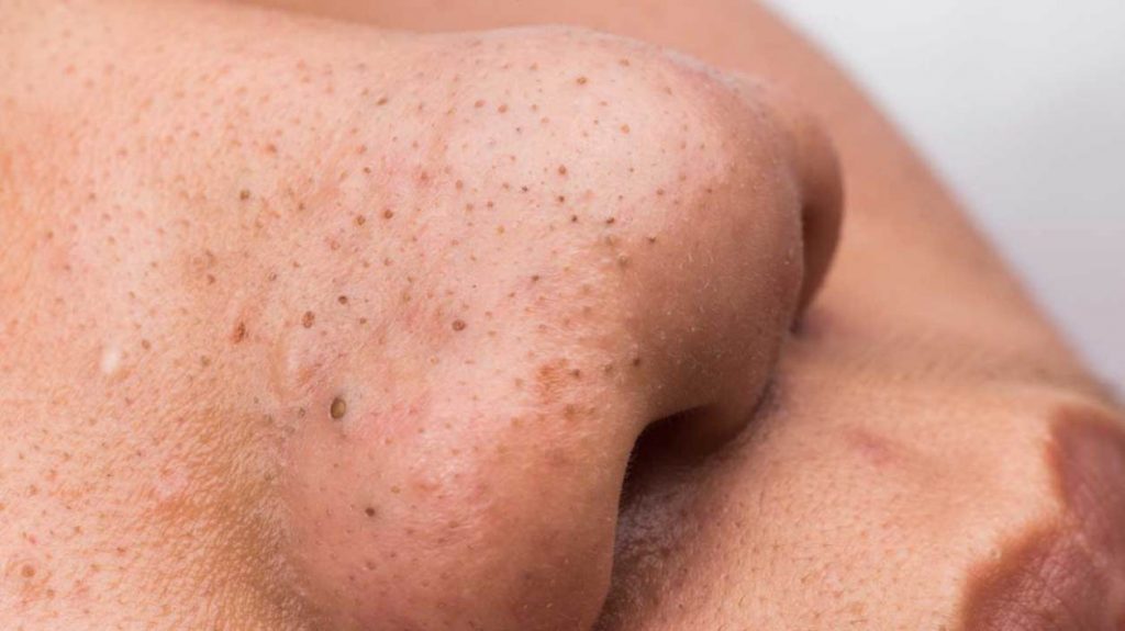 Blackheads on nose