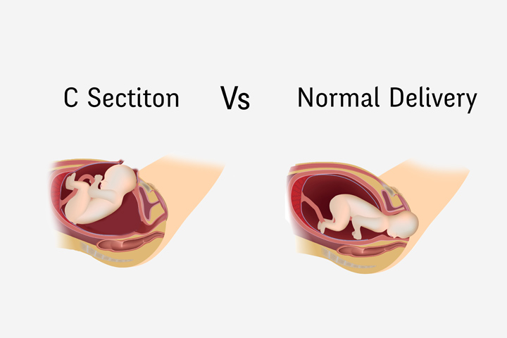 Vaginal/Natural birth vs C-Section.