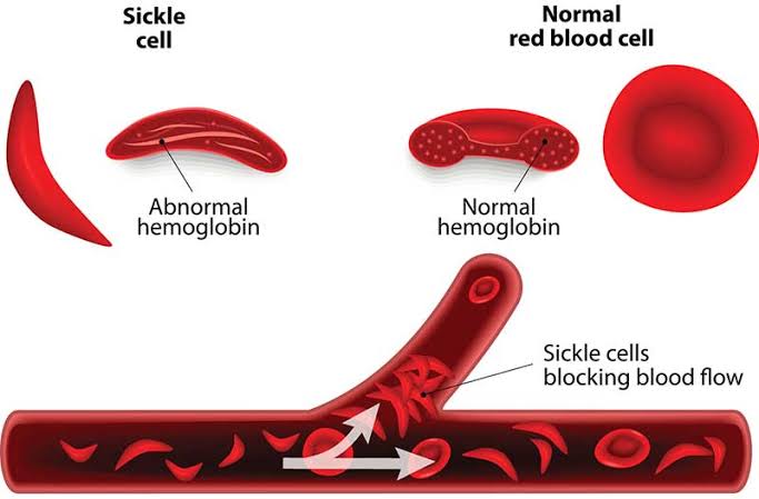 Blocking of blood flow by sickle cells in sickle cell disease
