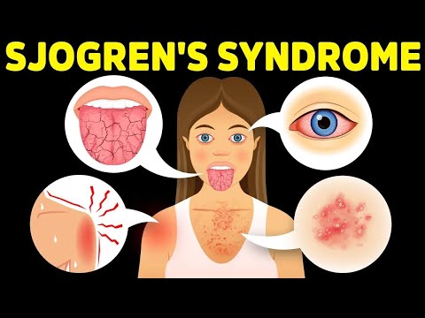 Sjogren's syndrome