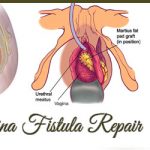 ipanel-vesico-vagina-fistula-repair