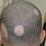 Alopecia