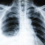 pleurisy