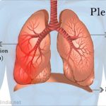 pleurisy-image