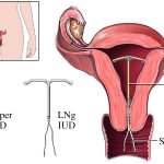 Intrauterine devices