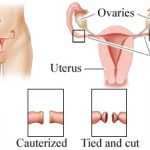 female sterilisation