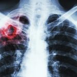 tuberculosis