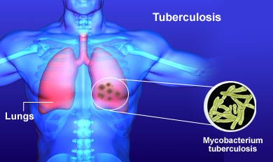 The infection process of TB bacteria - HealthFacts NG