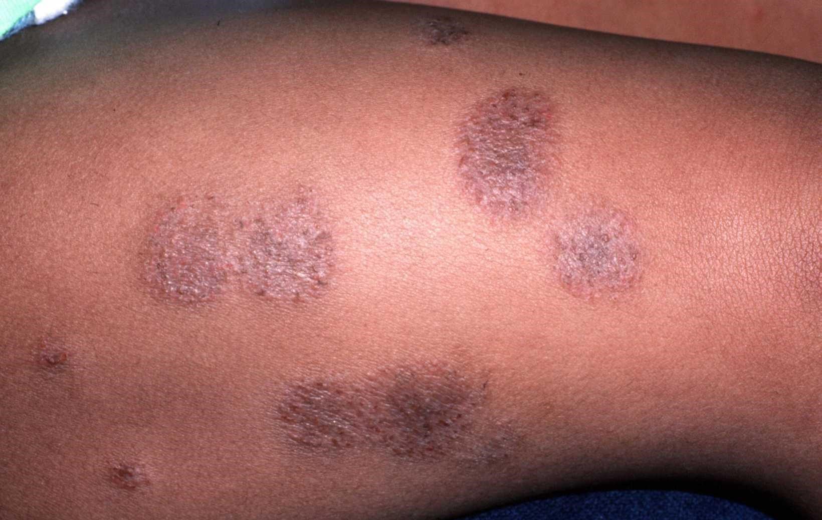 These Things Worsen Atopic Dermatitis Eczema Avoid Them Healthfactsng