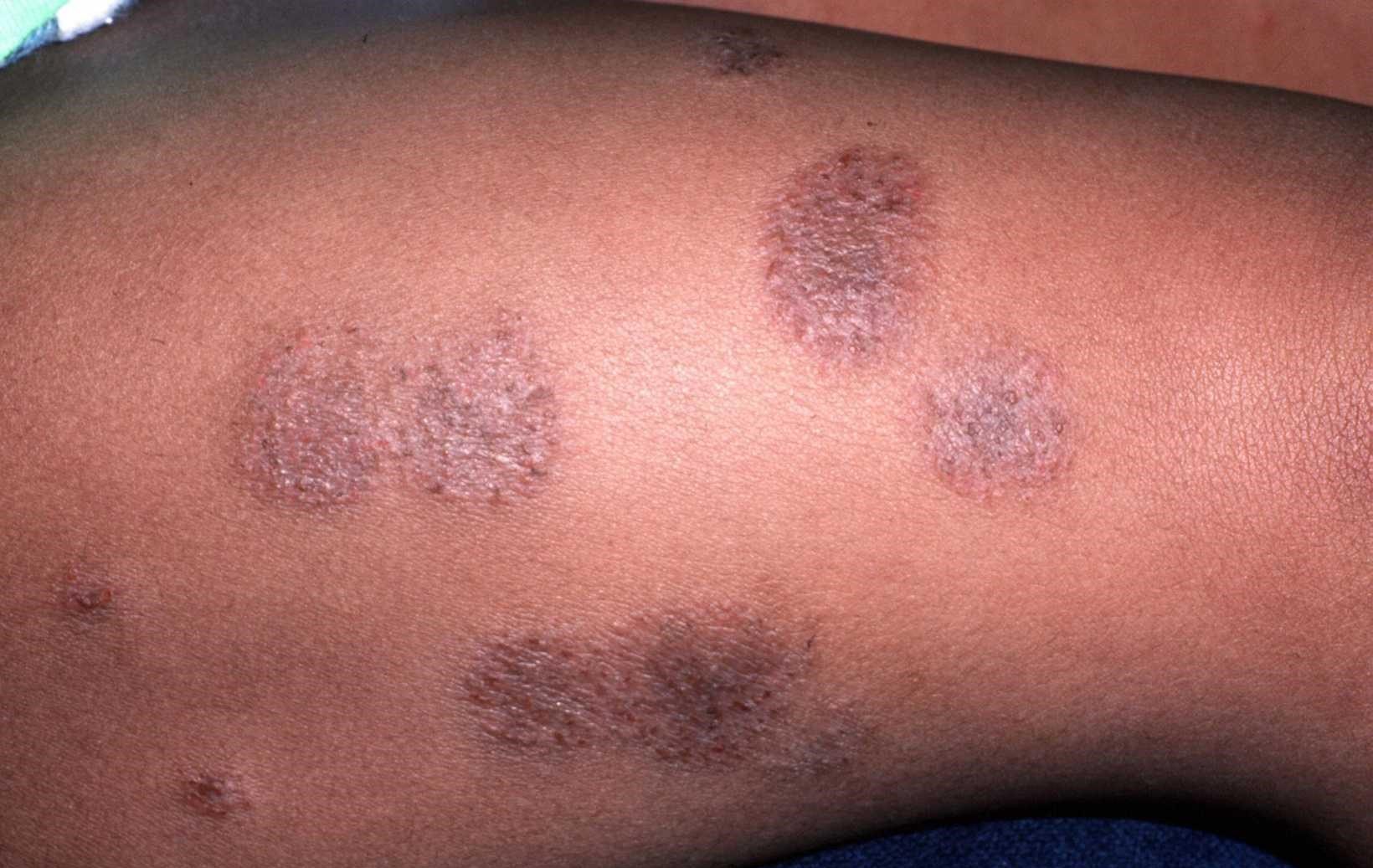 dermatitis-healthfacts-ng