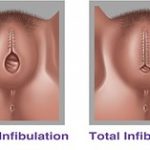 Female Genital Mutilation, Illustration