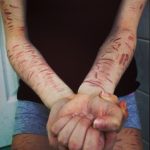 self-injury