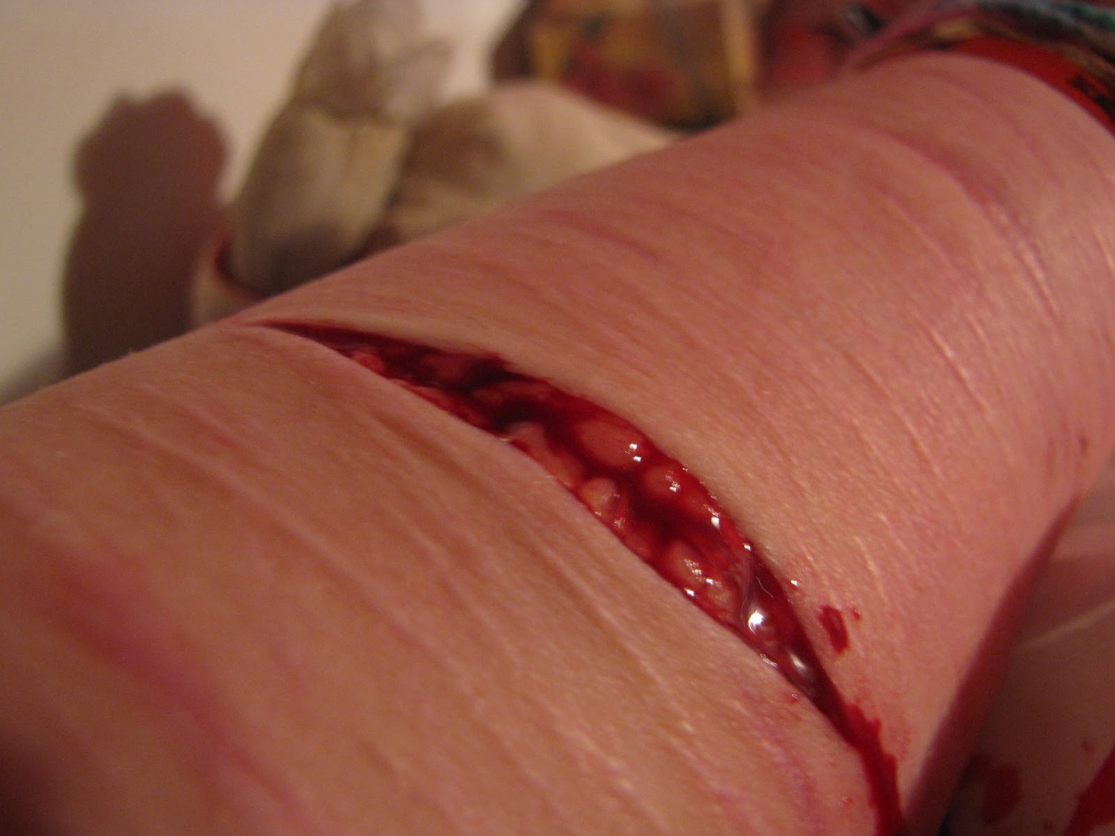 deep self harm cuts on arm