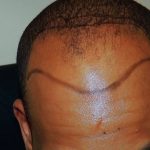 receding hairline11
