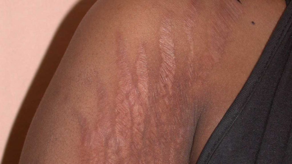 natural ways to deal with stretch marks