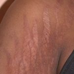 natural ways to deal with stretch marks