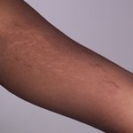stretchmarks2_jpg