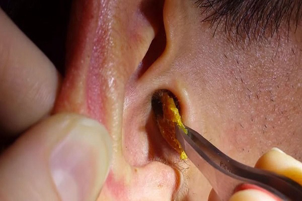 impacted earwax being extracted from an ear