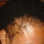 black woman traction alopecia_0