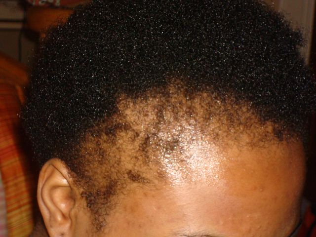 Traction Alopecia