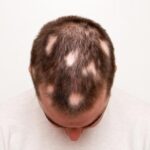 man-with-alopecia