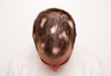 Man with Alopecia