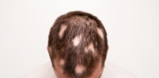Man with Alopecia