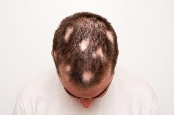Man with Alopecia