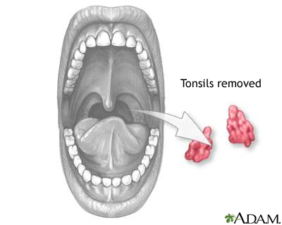 Tonsillectomy 