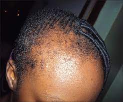 Traction alopecia on edges