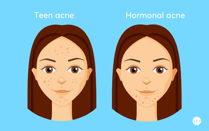 A picture showing the distribution of hormonal acne

