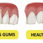 receding-gums-1