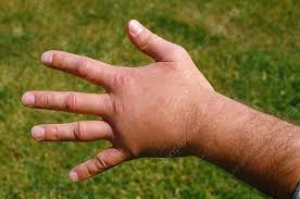 A picture of a hand stung by a bee
