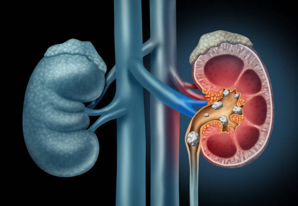 The truth about kidney stones.