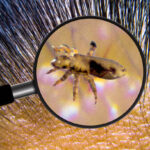 Lice are animals that feed on the blood of people on the scalp.