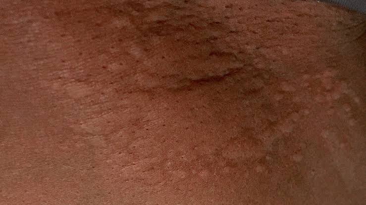  A picture showing Skin reactions - hives on black skin
