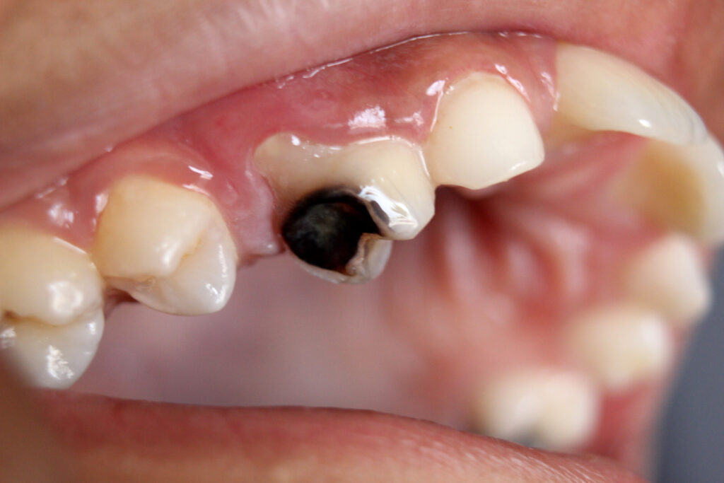 Dental caries, a complication of long term refined sugar consumption.
