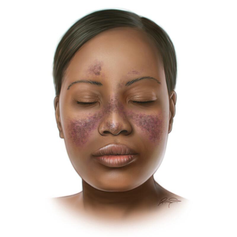 Everything You Need To Know About Systemic Lupus Erythematosus ...