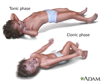 How to identify febrile seizures on the spot.
