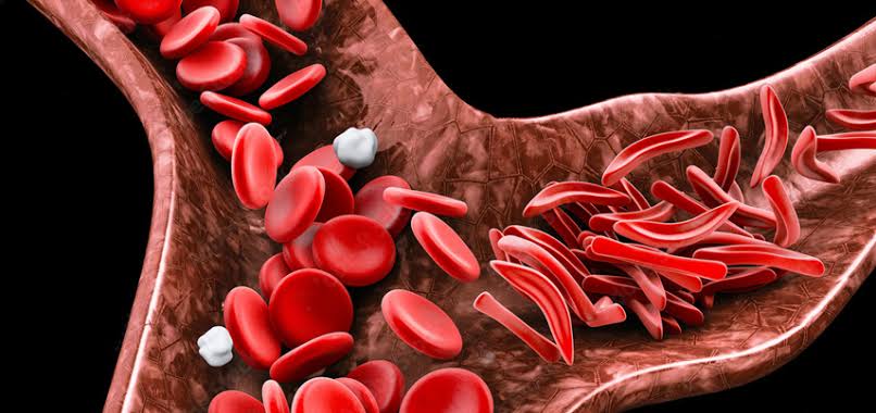 Sickle cell disease with sickle shaped cells
