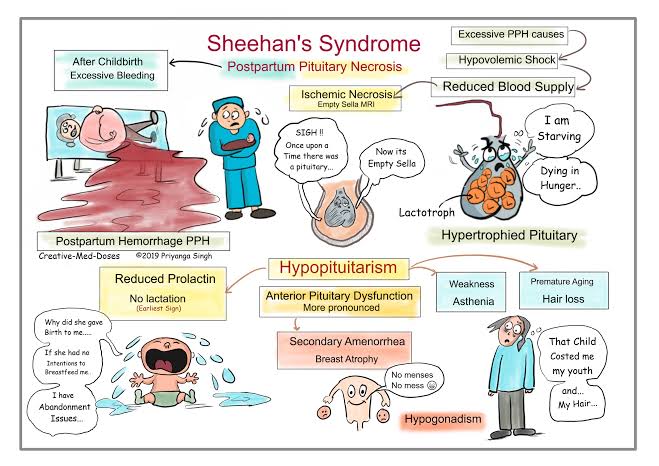 A pictorial illustration of Sheehan's syndrome
