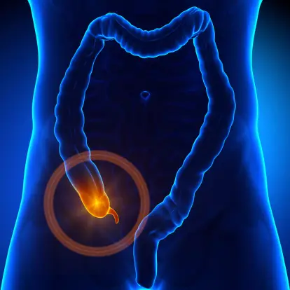 Take this short quiz on appendicitis!