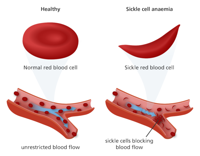 The New Cure For Sickle Cell Disease Healthfacts