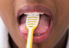 oral thrush
