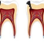 human-stages-tooth-decay_1308-92373